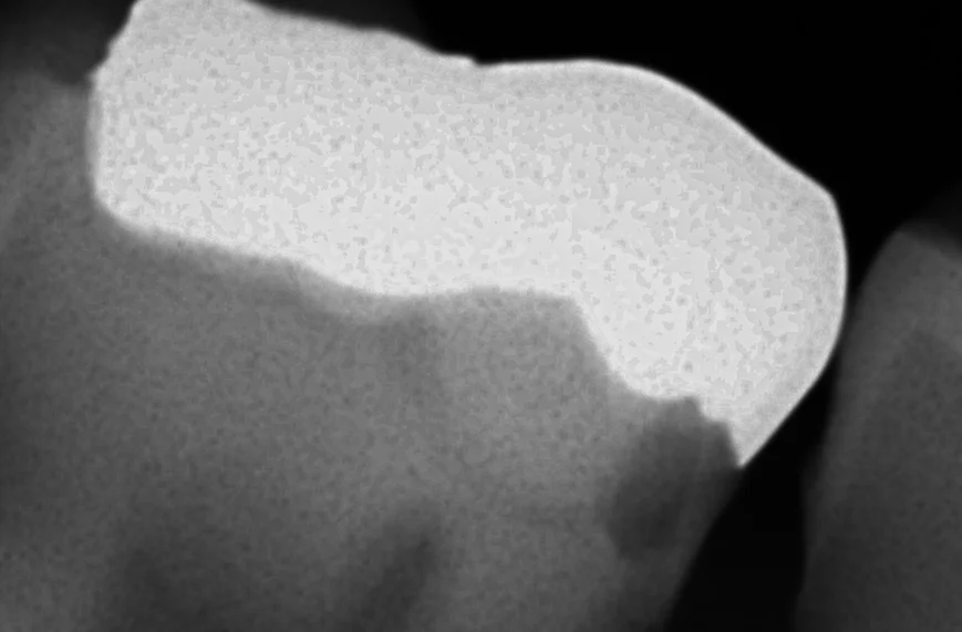 難易度の高い白い詰め物。｜坂寄歯科医院（取手市藤代） - 画像6