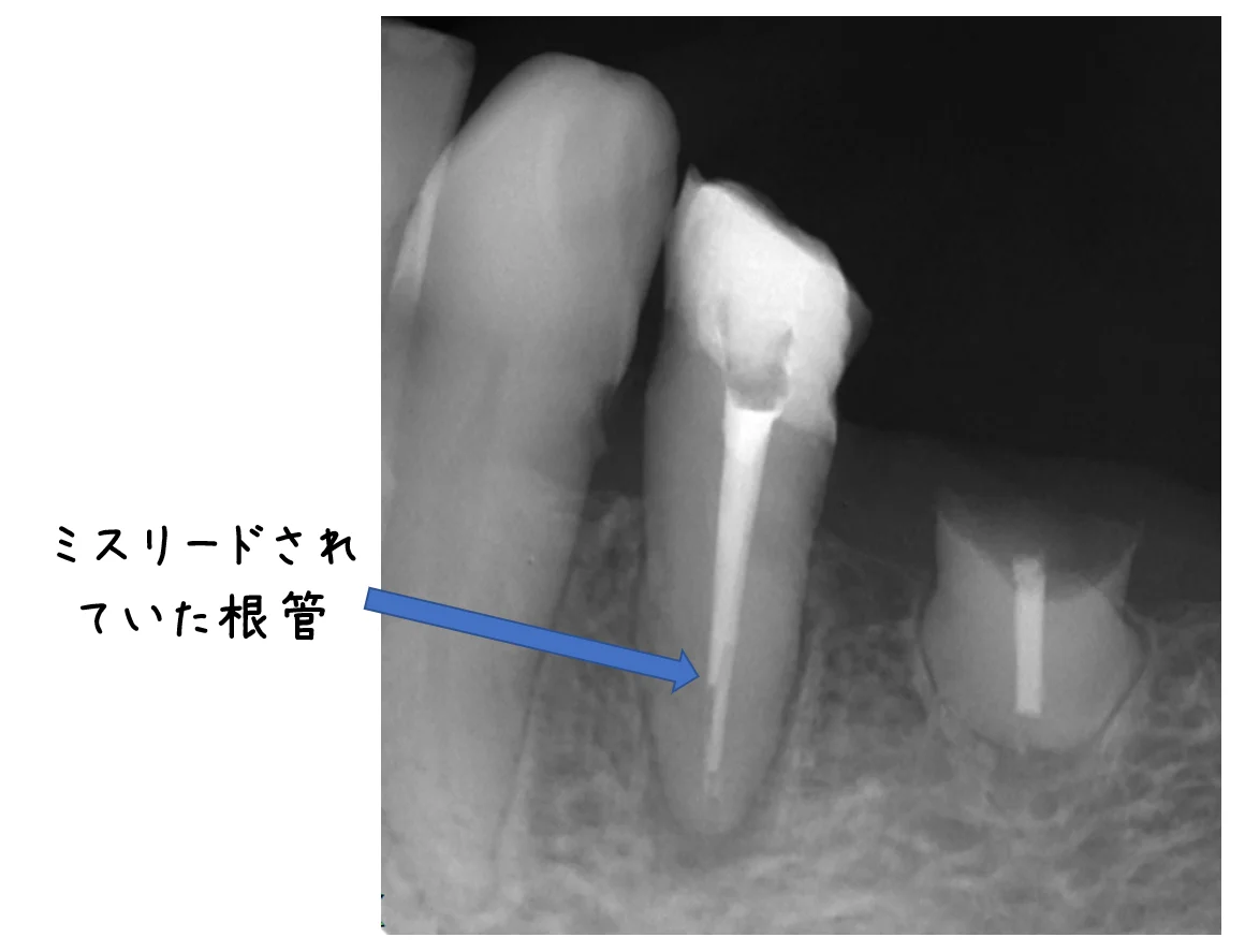 神経の治療④|坂寄歯科医院(取手市藤代) - 画像2