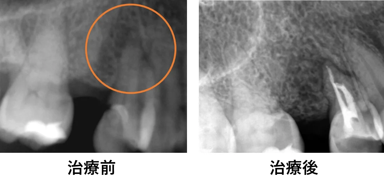 ダイレクトボンディング④｜坂寄歯科医院（取手市藤代） - 画像8