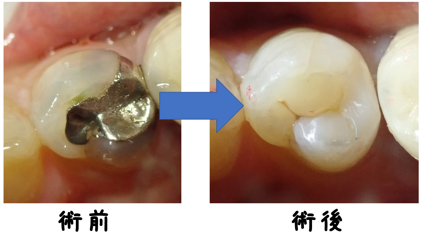 ダイレクトボンディング|坂寄歯科医院(取手市藤代) - 画像5