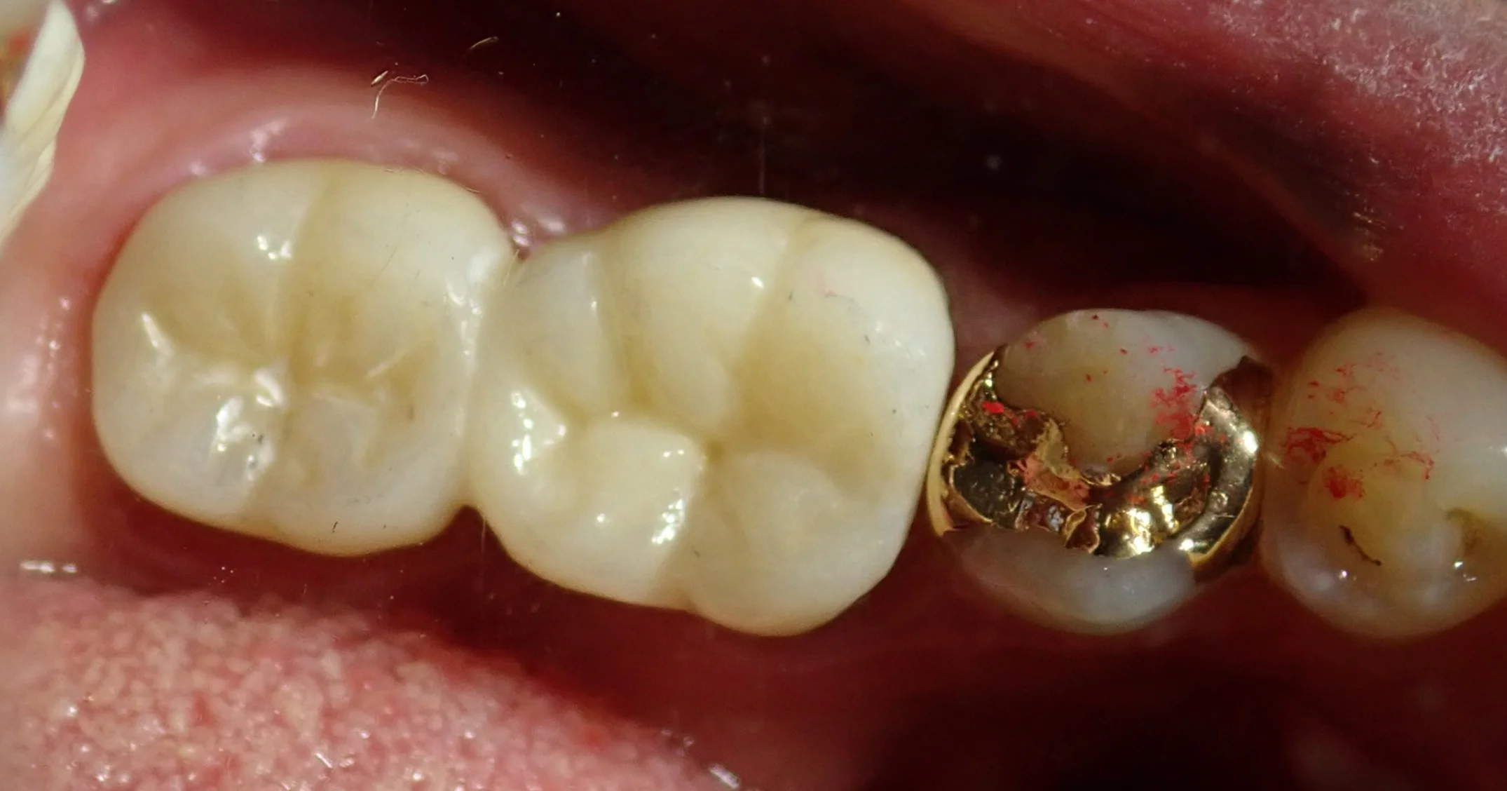 その抜歯ちょっと待って!|坂寄歯科医院(取手市藤代) - 画像7