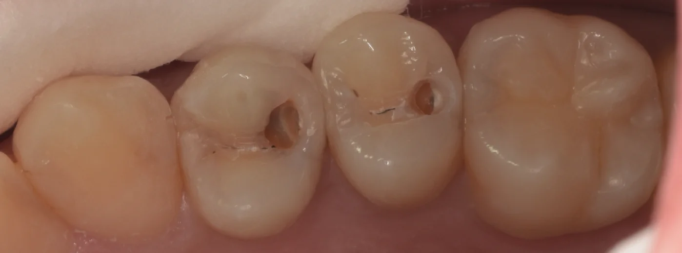 通常の保険診療。|坂寄歯科医院(取手市藤代) - 画像2