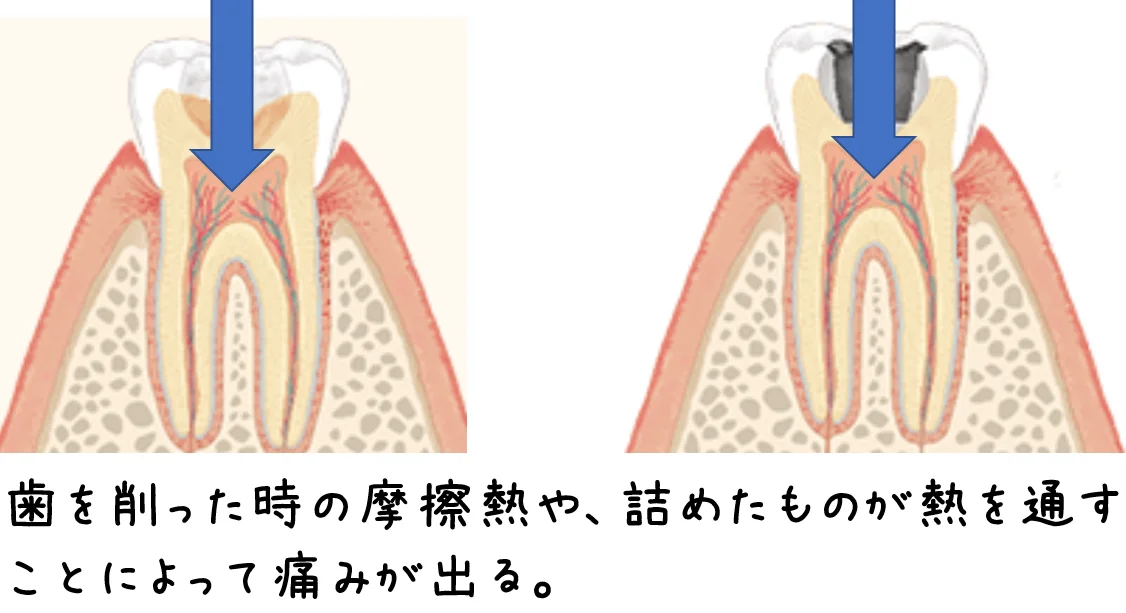 Q&A～今まで痛くなかった歯を治療したことで痛みが出てしまうのか～｜坂寄歯科医院（取手市藤代） - 画像4