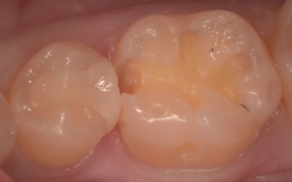 歯科医師の歯を1日で本物の歯のように。｜坂寄歯科医院（取手市藤代） - 画像2