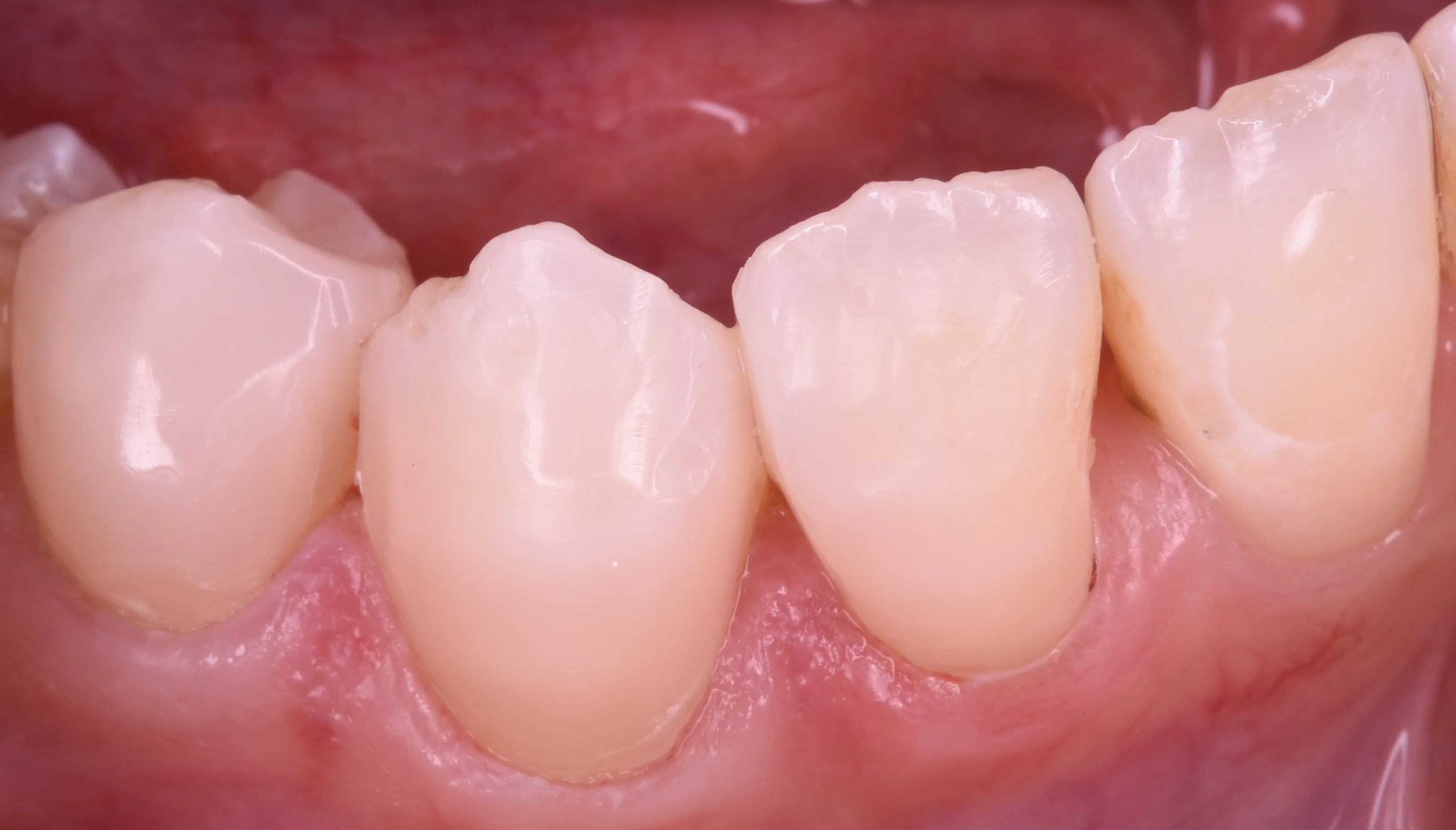 前歯を纏めて白く。|坂寄歯科医院(取手市藤代) - 画像3