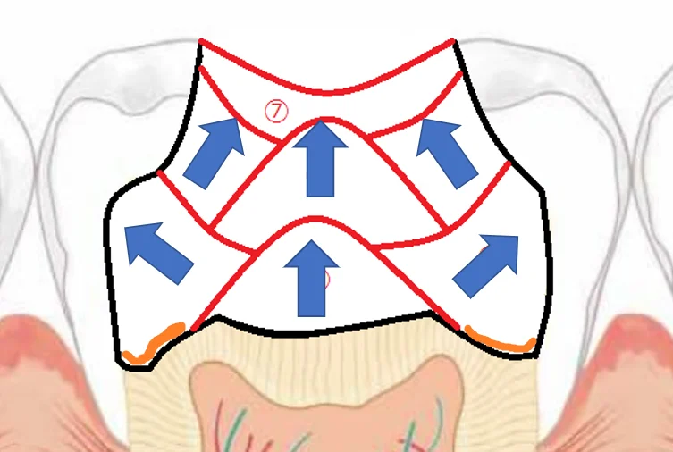 【歯科医師向け】重合収縮のコントロールについて【1級窩洞編】｜坂寄歯科医院（取手市藤代） - 画像9