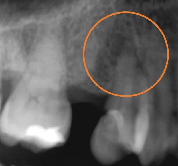 ダイレクトボンディング④｜坂寄歯科医院（取手市藤代） - 画像2
