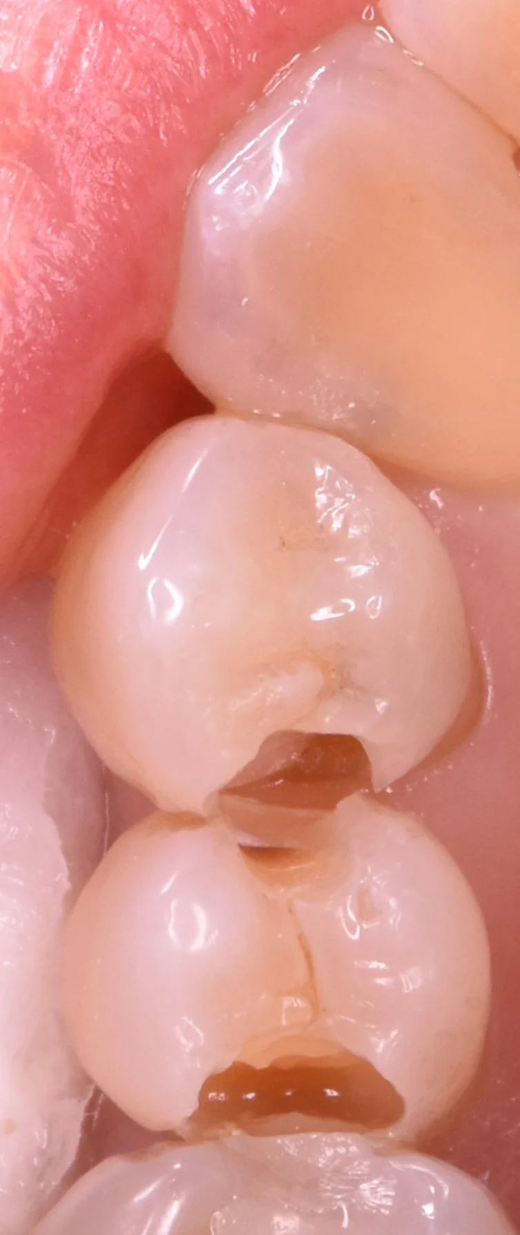 奥歯の歯並びが悪くなってしまっている所の治療|坂寄歯科医院(取手市藤代) - 画像2