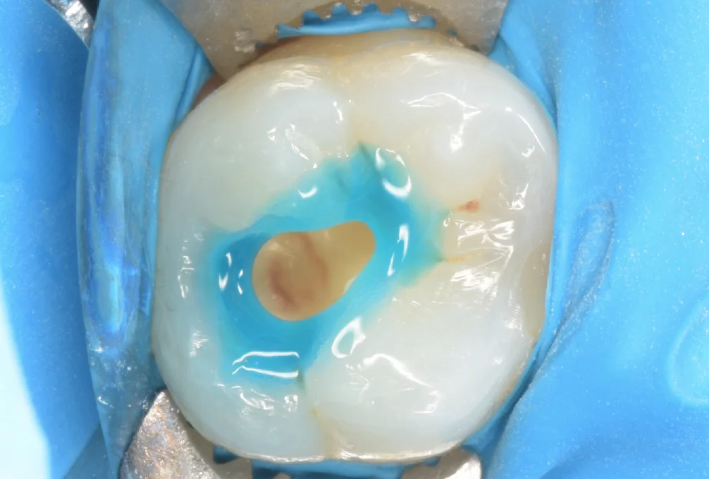 印西からお越しの方。｜坂寄歯科医院（取手市藤代） - 画像4