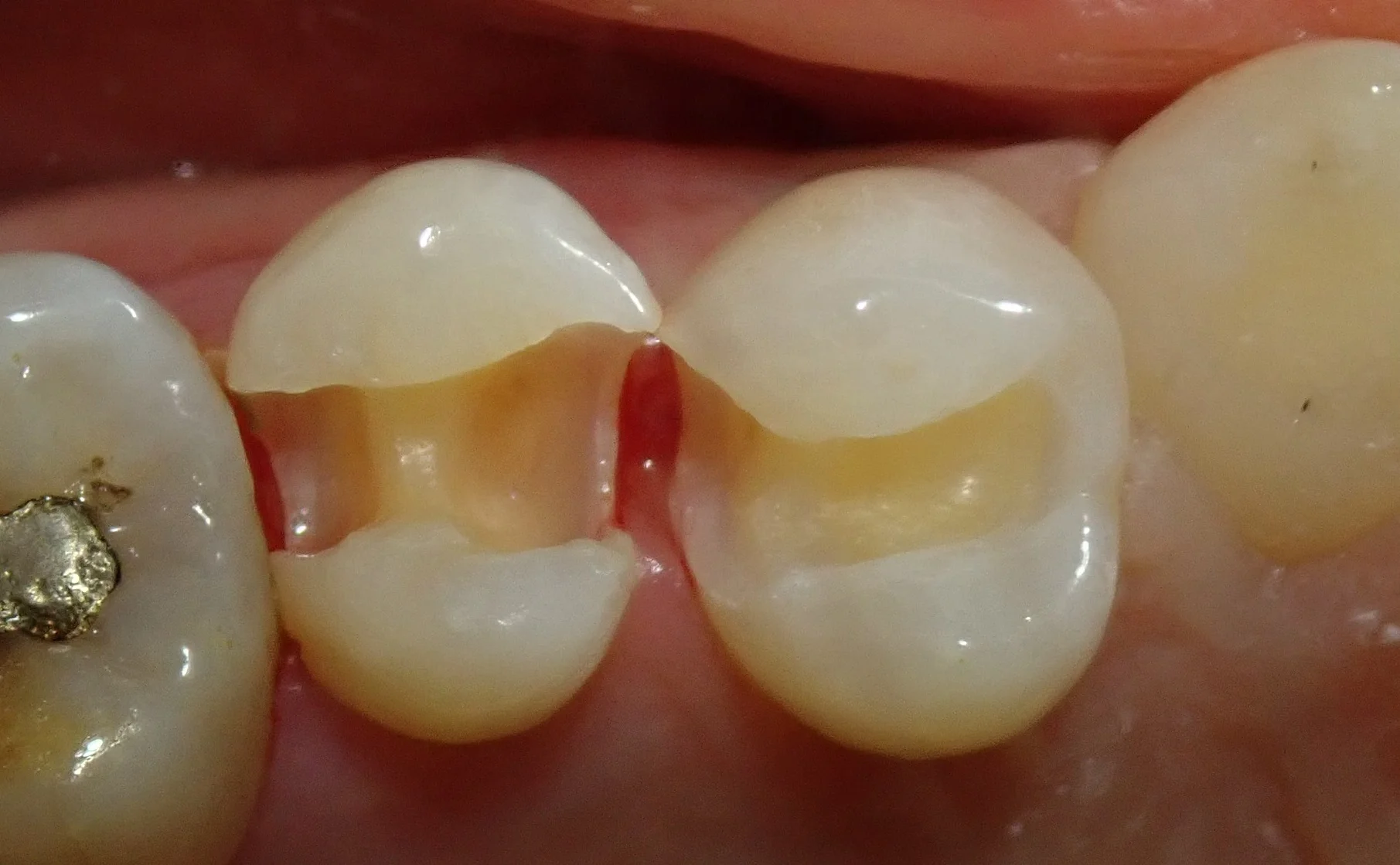 保険の白い詰め物｜坂寄歯科医院（取手市藤代） - 画像4