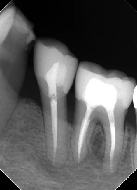 レジンでは無理ですって!再び・・・。|坂寄歯科医院(取手市藤代) - 画像3