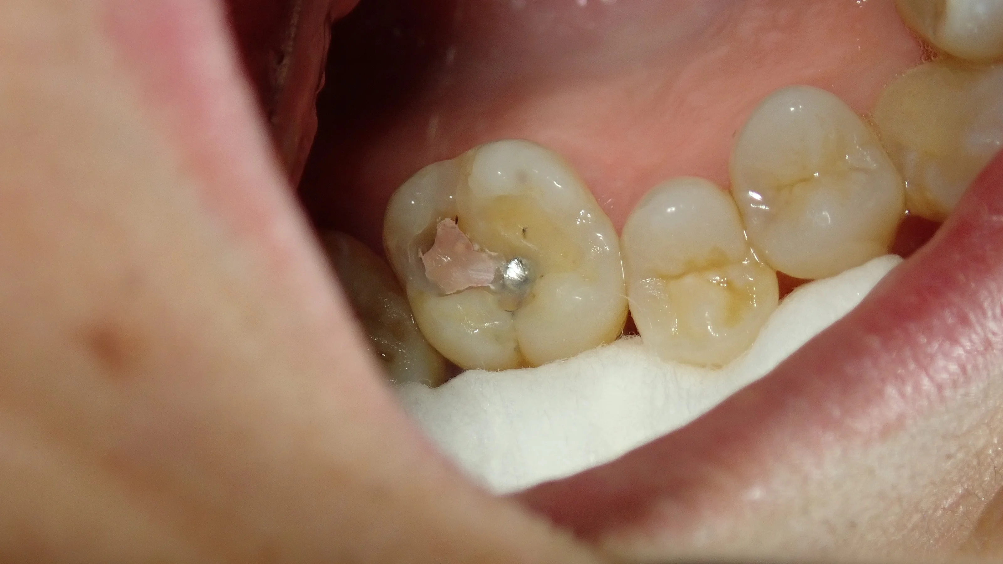 右上6ダイレクトボンディング｜坂寄歯科医院（取手市藤代） - 画像2