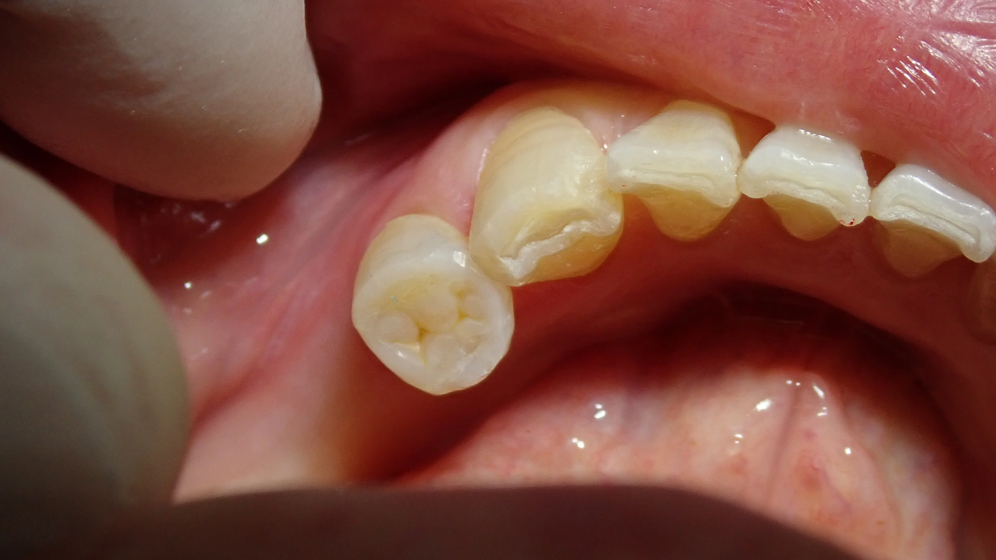 左下奥歯白い詰め物|坂寄歯科医院(取手市藤代) - 画像2