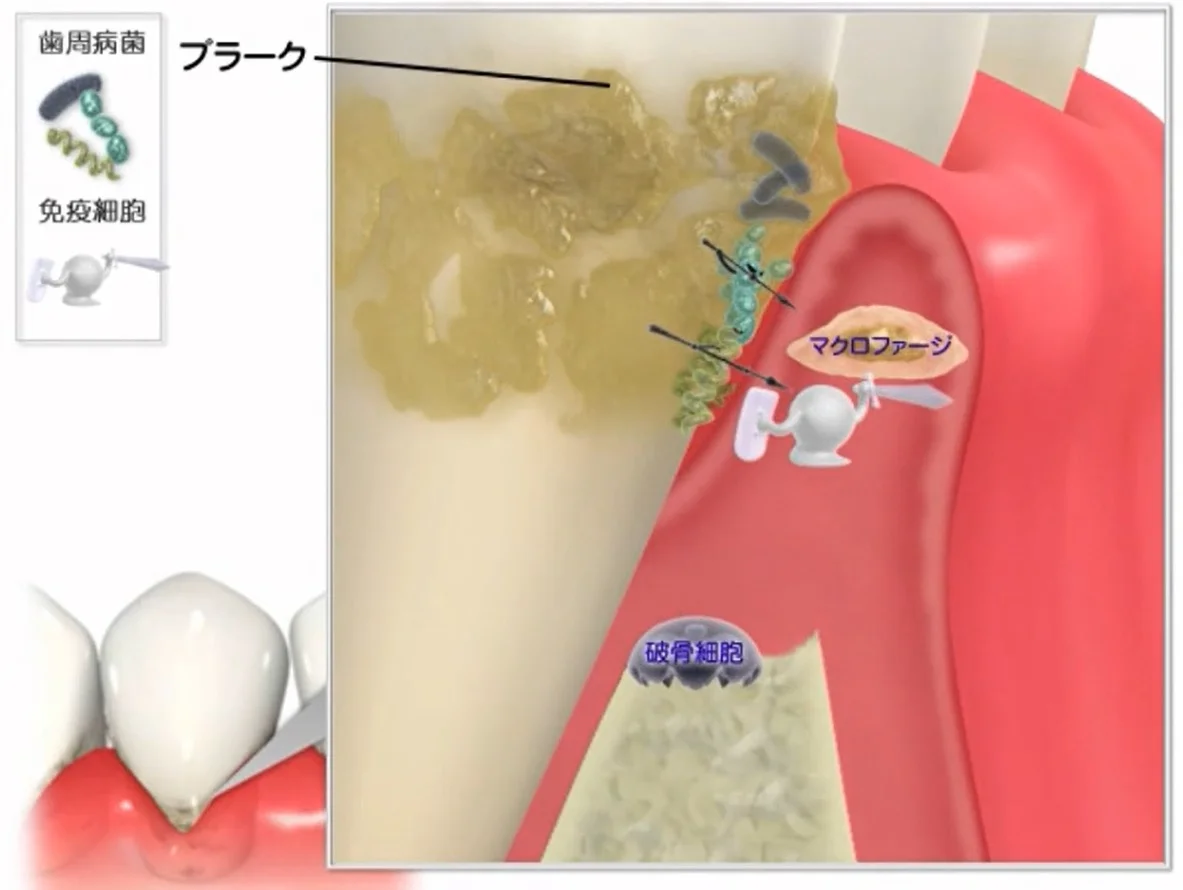 Q&A～歯周病ってなに？②～｜坂寄歯科医院（取手市藤代） - 画像3