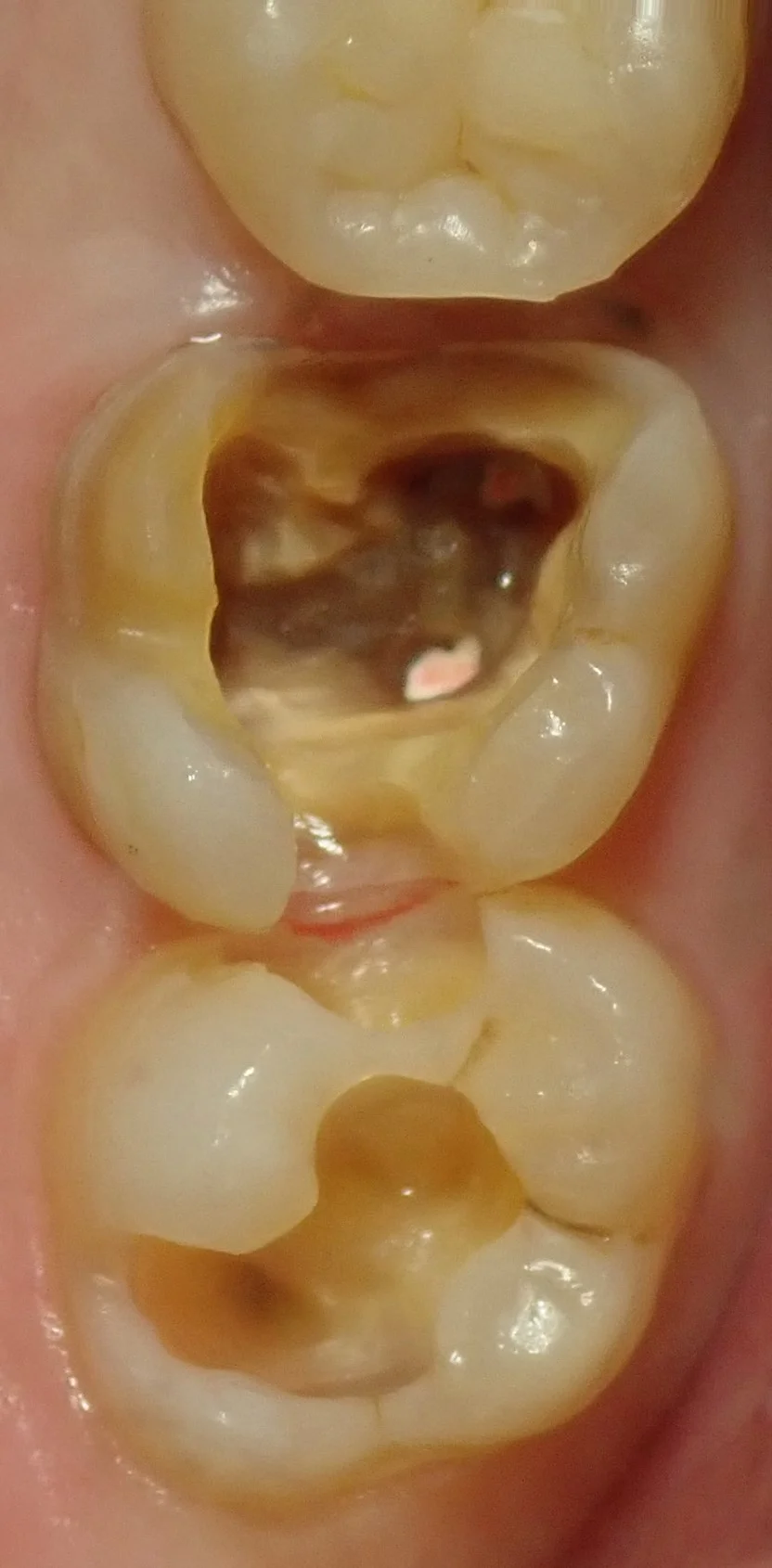 左上奥歯の白い詰め物｜坂寄歯科医院（取手市藤代） - 画像3