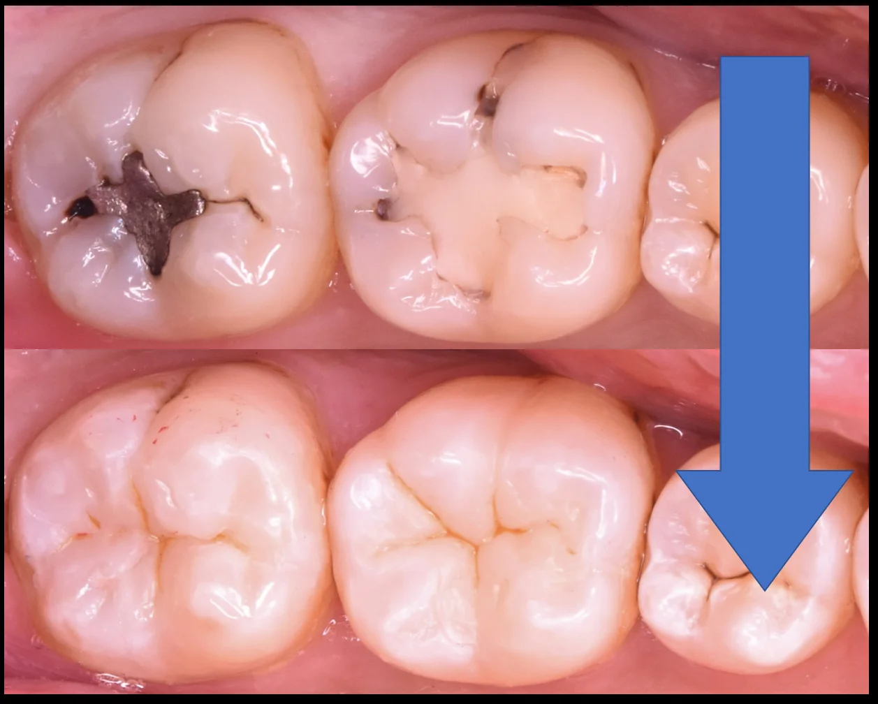 奥歯2本の治療を1日で。｜坂寄歯科医院（取手市藤代） - 画像5