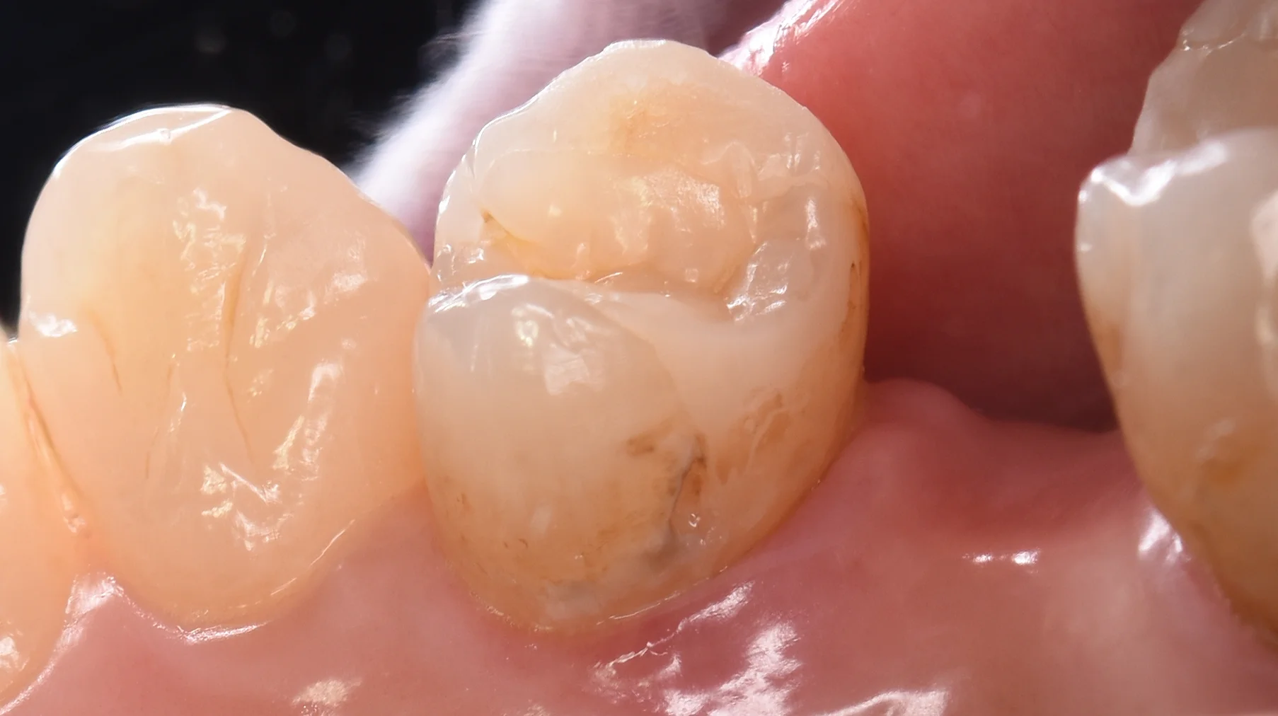 ダイレクトボンディング術後4年での補修修復｜坂寄歯科医院（取手市藤代） - 画像2