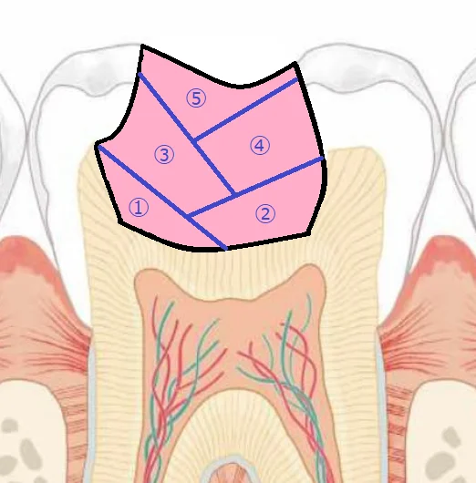 【歯科医師向け】重合収縮のコントロールについて【1級窩洞編】｜坂寄歯科医院（取手市藤代） - 画像2