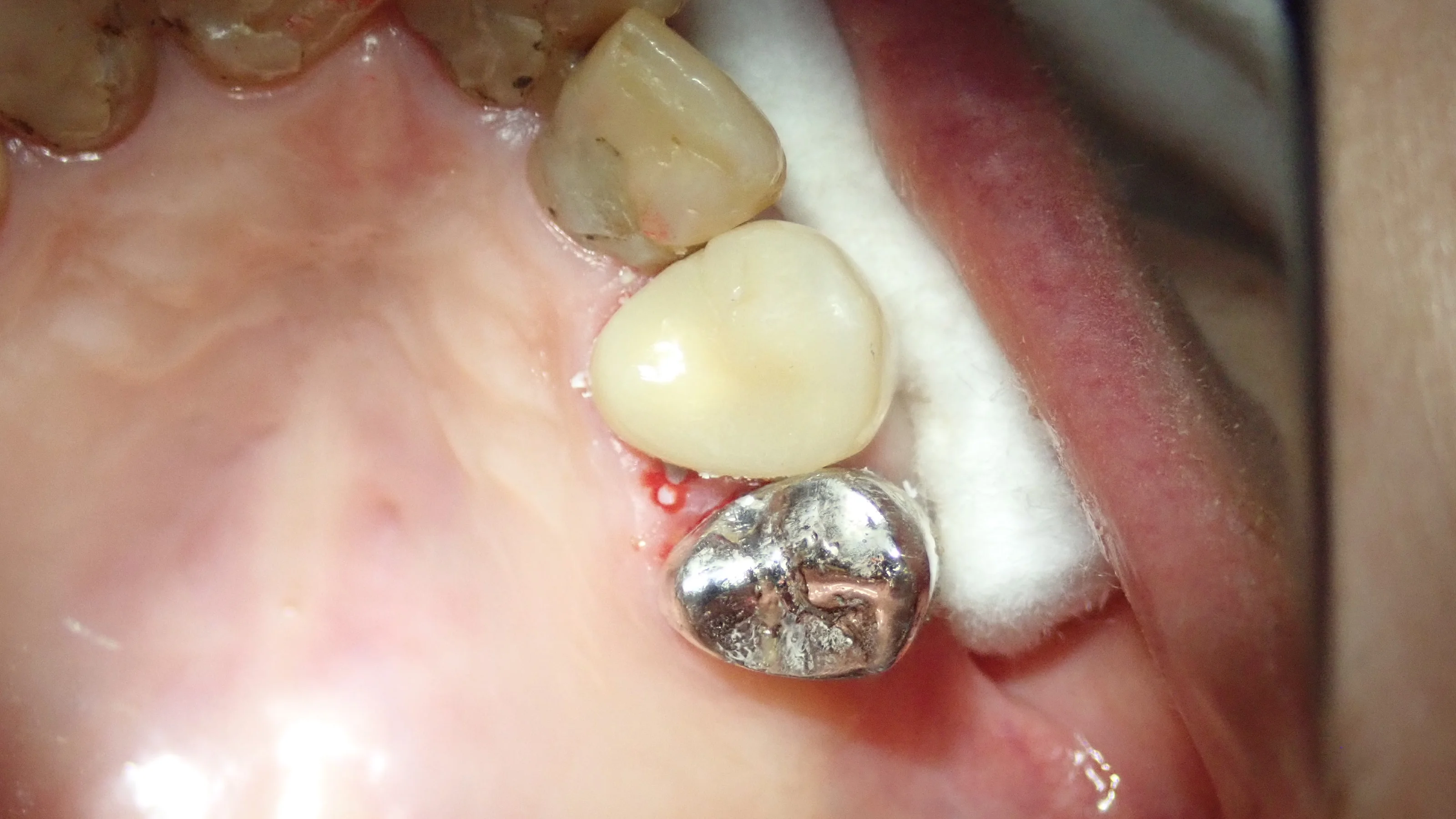 硬質レジンジャケット冠｜坂寄歯科医院（取手市藤代） - 画像5