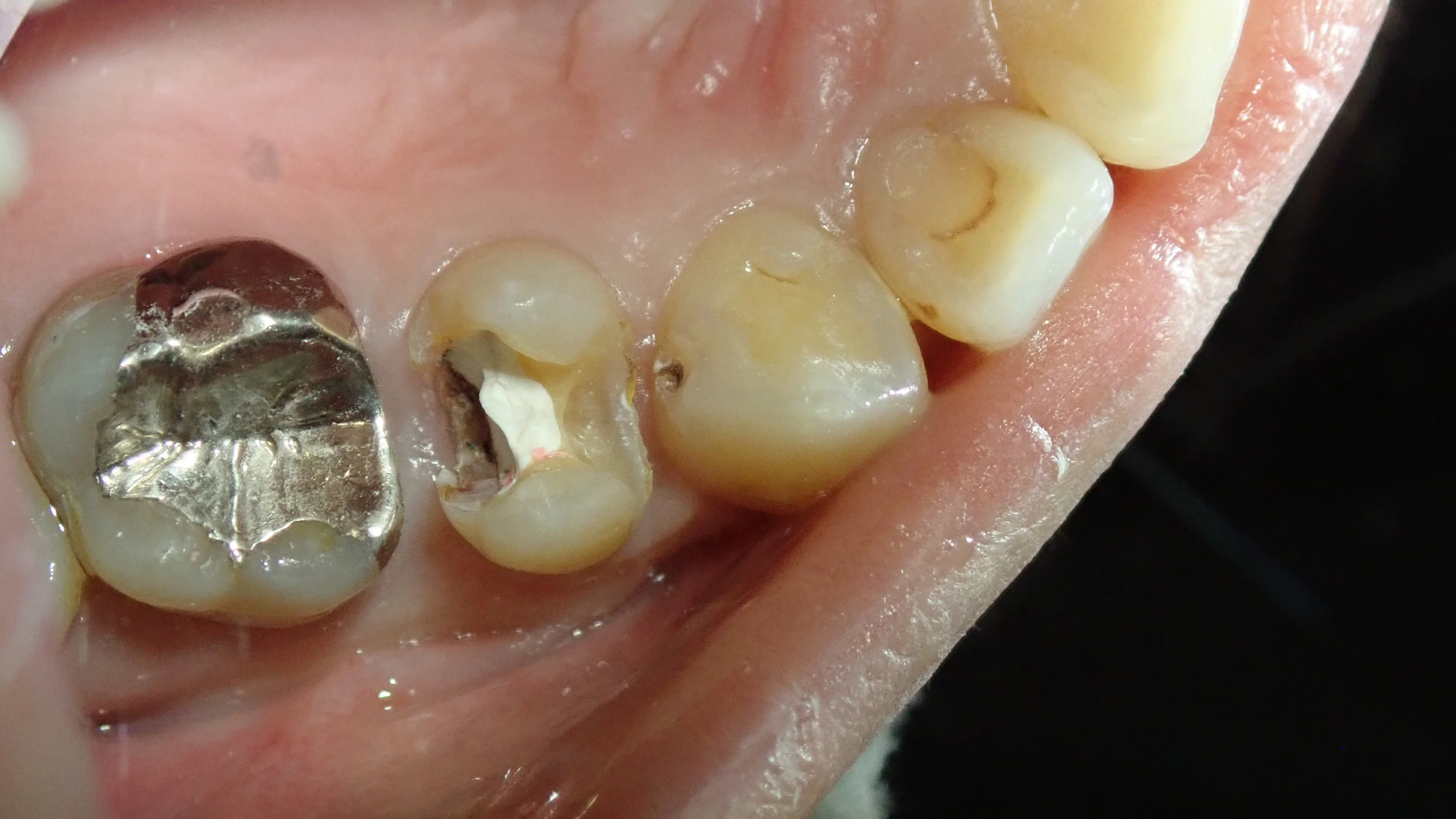 犬歯と奥歯の白い詰め物｜坂寄歯科医院（取手市藤代） - 画像2