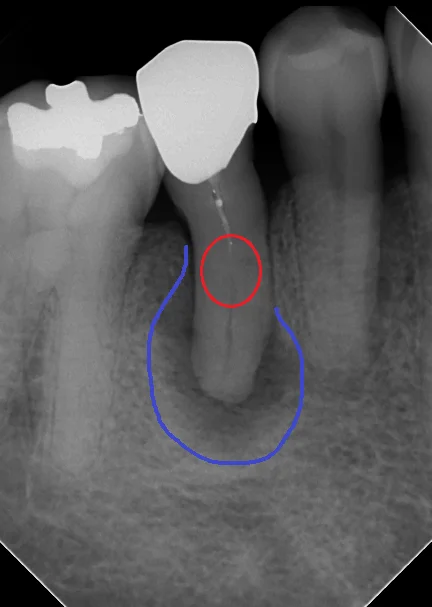 閉鎖根管の治療には根気が必要|坂寄歯科医院(取手市藤代) - 画像2