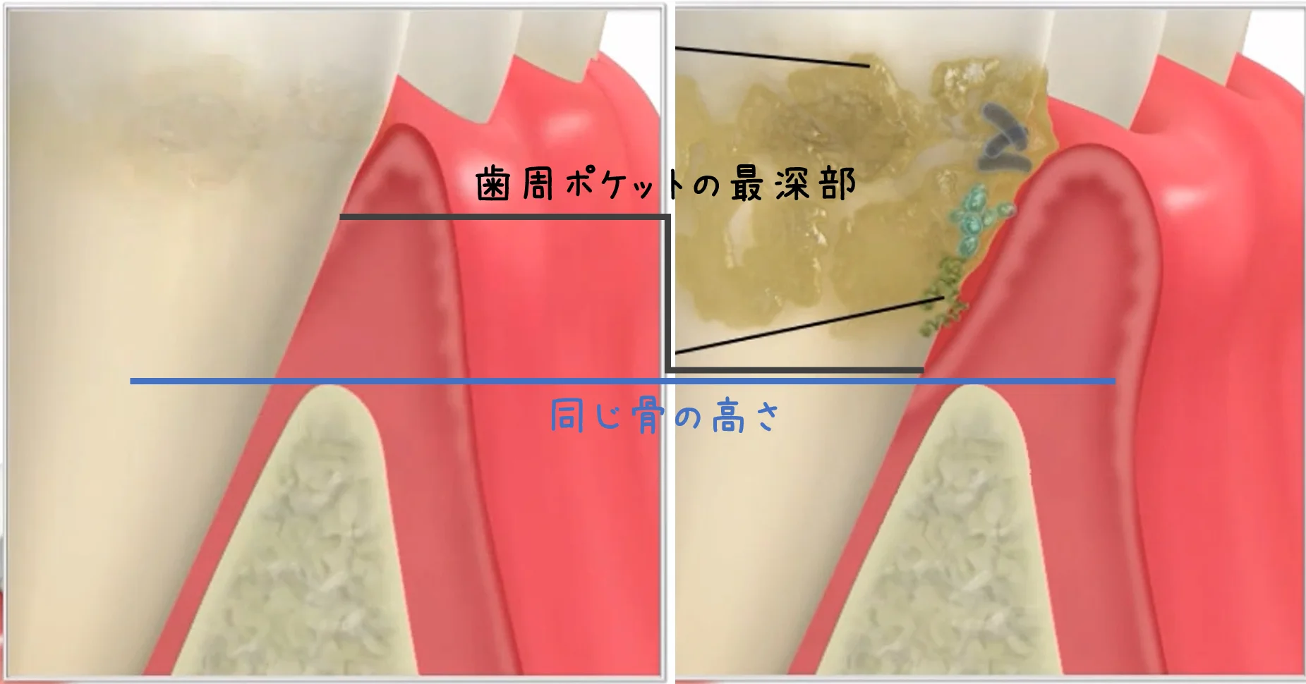 Q&A～歯周病ってなに？②～｜坂寄歯科医院（取手市藤代） - 画像2