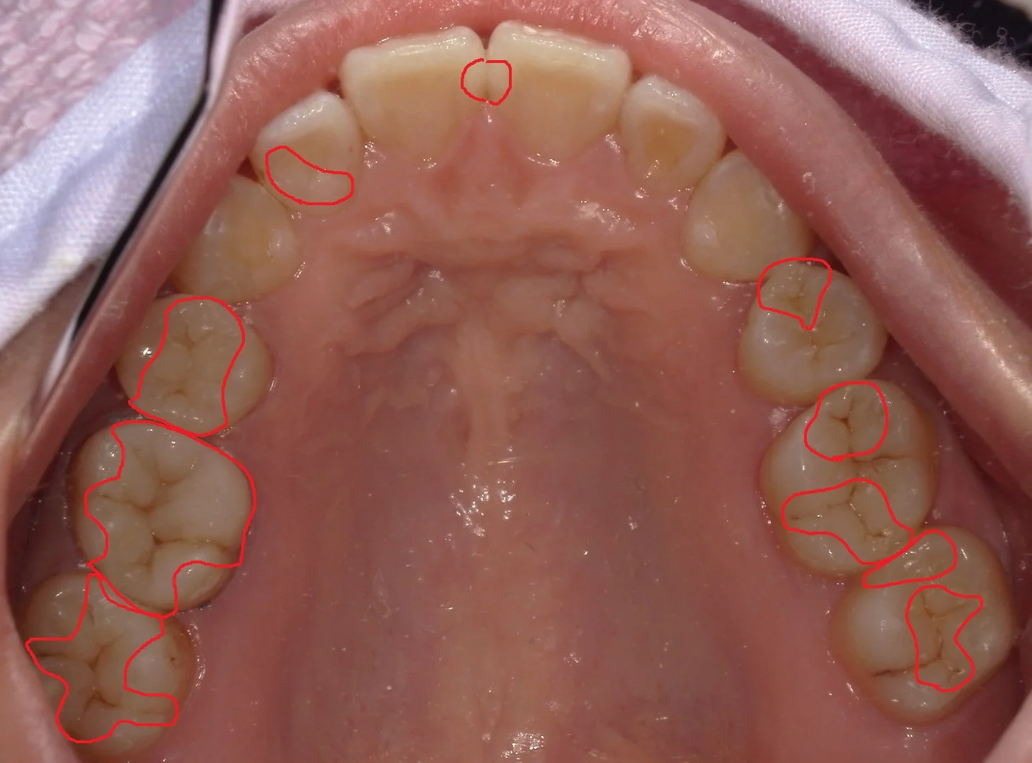 全顎的に白い詰め物で治した症例|坂寄歯科医院(取手市藤代) - 画像3