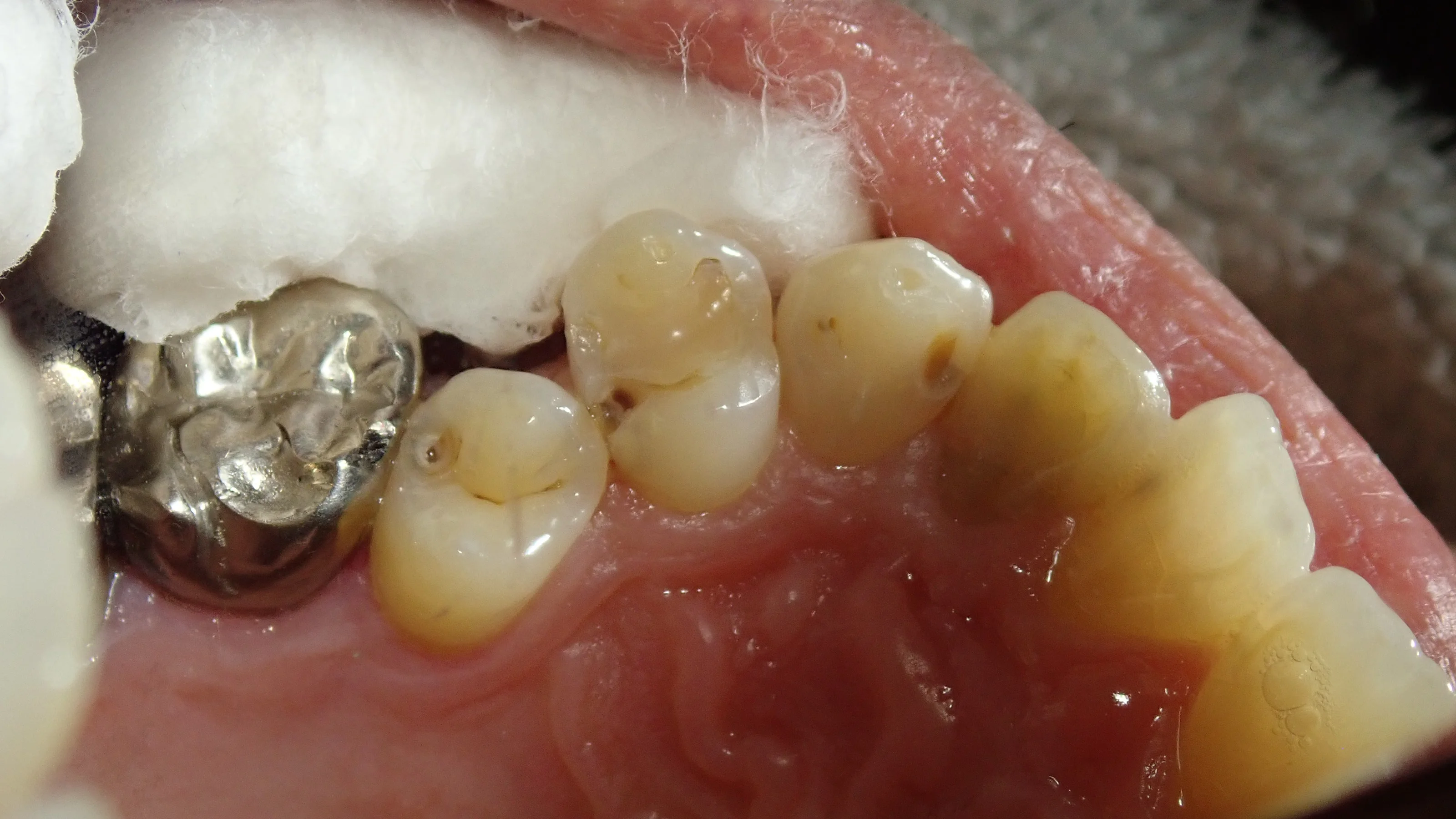 左上3本まとめてダイレクトボンディング｜坂寄歯科医院（取手市藤代） - 画像2