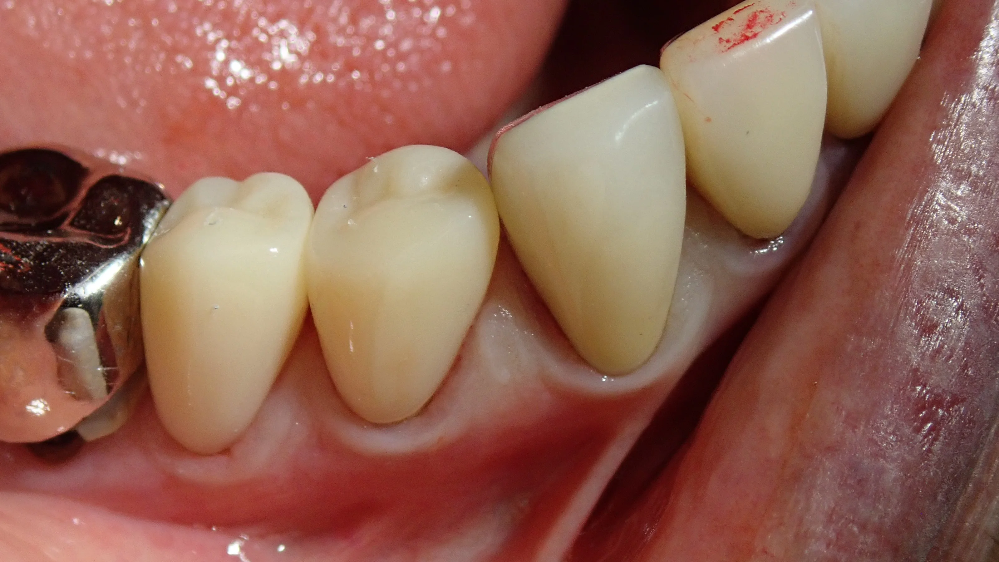 CAD/CAM冠について|坂寄歯科医院(取手市藤代) - 画像2