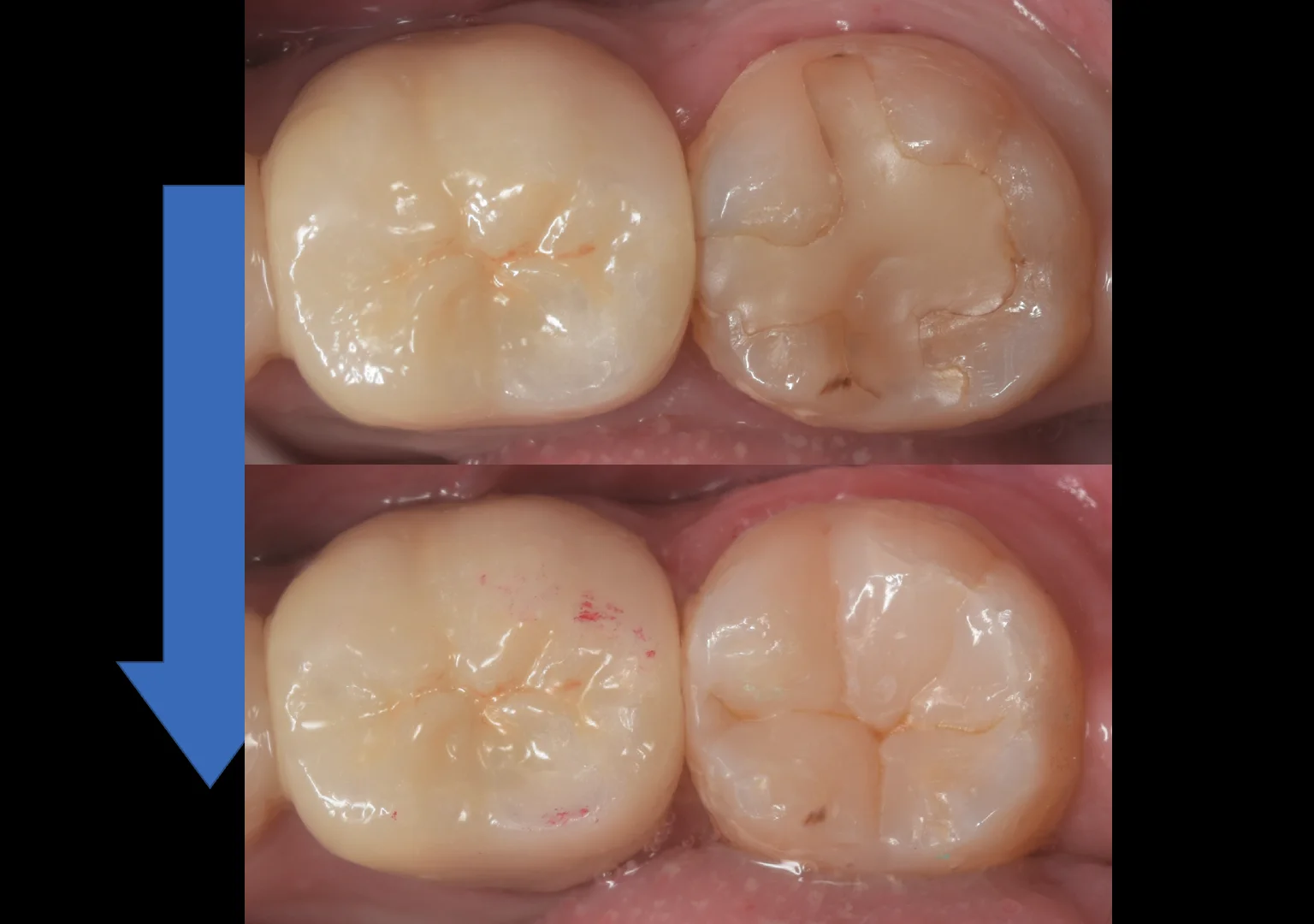 古い白い詰め物を詰め直し｜坂寄歯科医院（取手市藤代） - 画像5
