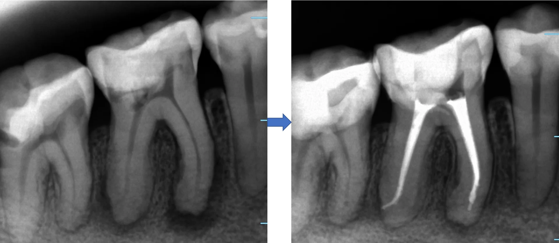 神経の治療②｜坂寄歯科医院（取手市藤代） - 画像4
