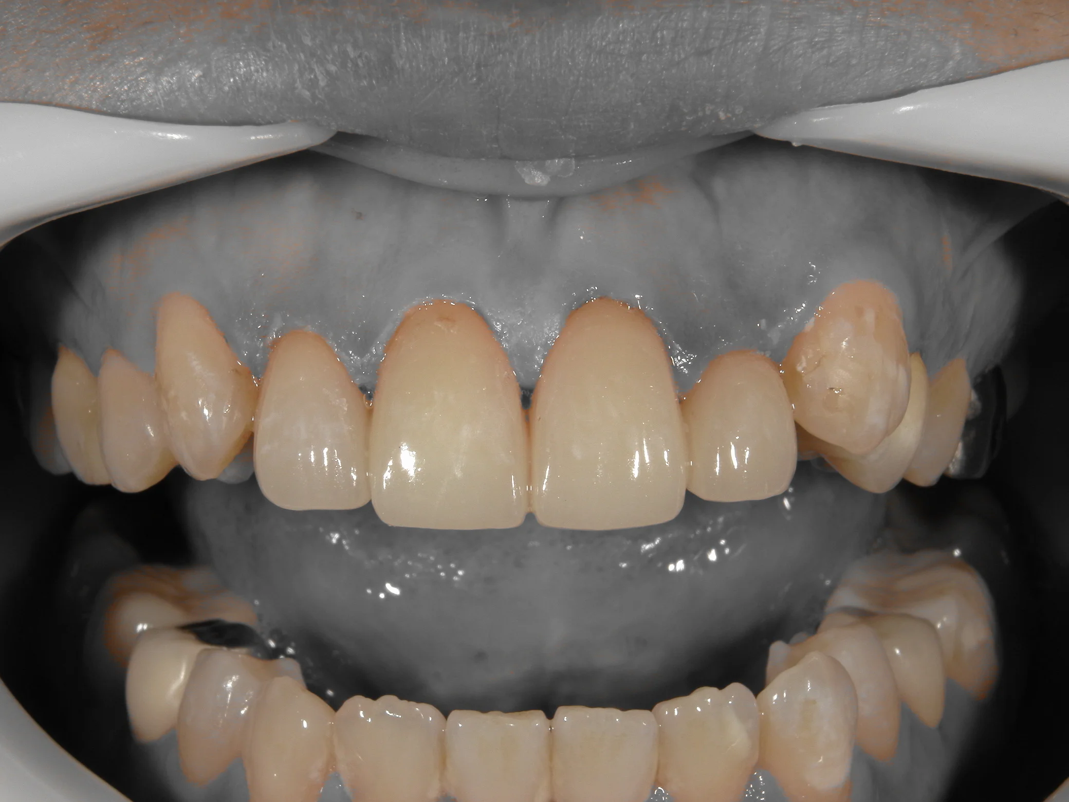 前歯セラミッククラウン｜坂寄歯科医院（取手市藤代） - 画像3