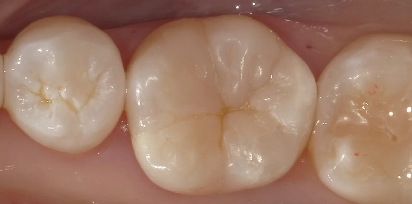 他院勤務中の歯科衛生士さんの治療を行いました。|坂寄歯科医院(取手市藤代) - 画像3