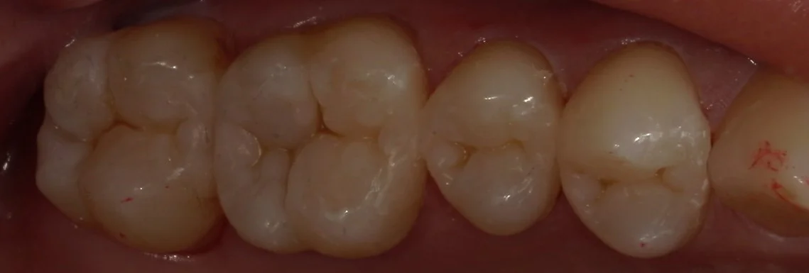 全体的に金属を白い詰め物に。|坂寄歯科医院(取手市藤代) - 画像4