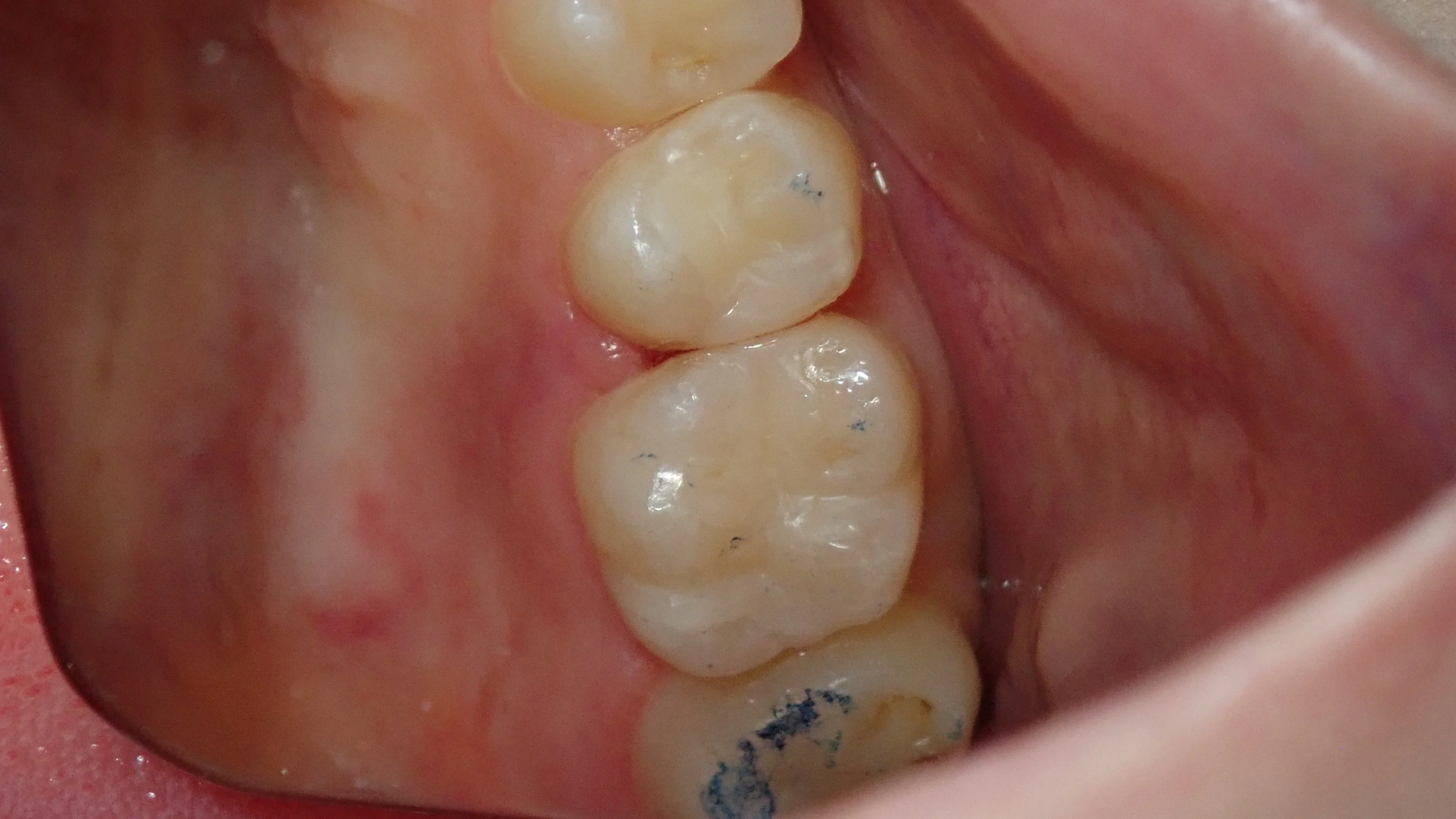 コンポジットレジン②｜坂寄歯科医院（取手市藤代） - 画像4