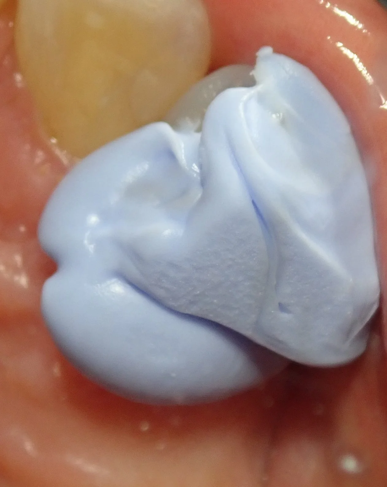 右上犬歯の白い詰め物|坂寄歯科医院(取手市藤代) - 画像3