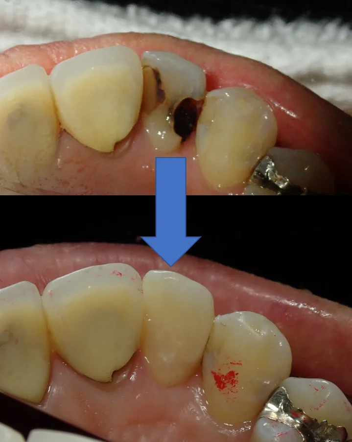 前歯ダイレクトボンディング｜坂寄歯科医院（取手市藤代） - 画像7