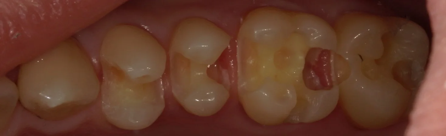 全体的に金属を白くしたいという方の治療｜坂寄歯科医院（取手市藤代） - 画像3