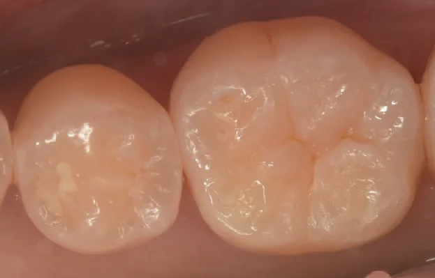 様子を見ていた所が進んだため治療介入。|坂寄歯科医院(取手市藤代) - 画像4