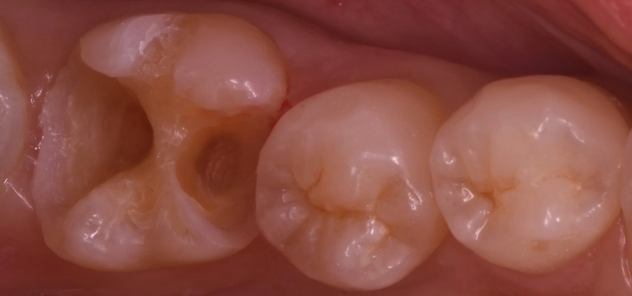 詰め物が脱離した所を即日で白い詰め物に。|坂寄歯科医院(取手市藤代) - 画像3