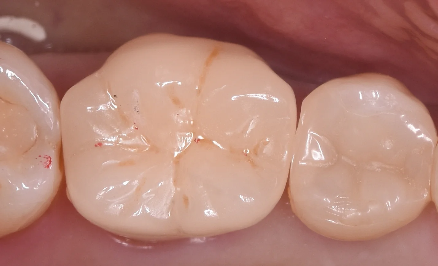 歯の亀裂で痛みが出たため、被せ物に。|坂寄歯科医院(取手市藤代) - 画像3