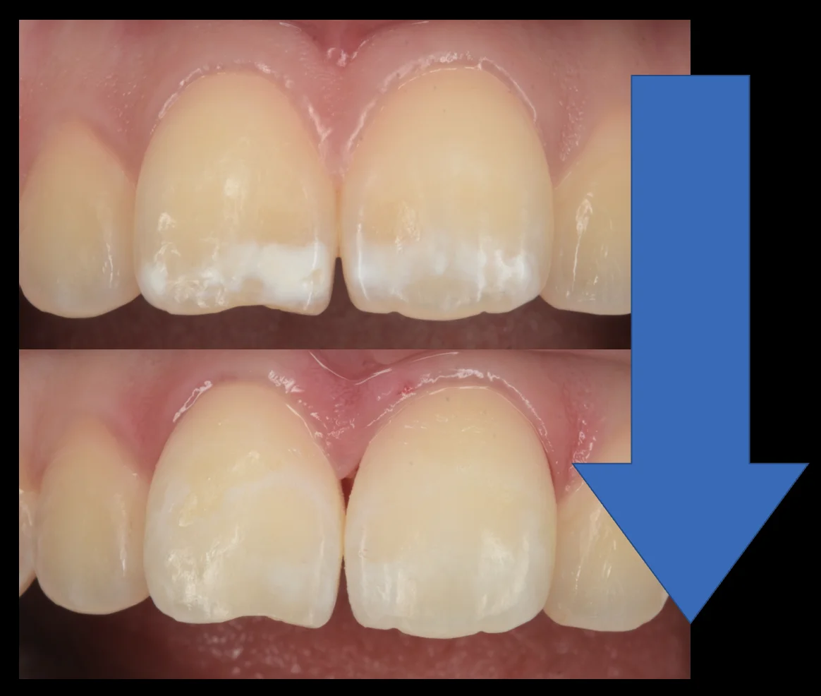 遠方よりICON治療を求めて・・・｜坂寄歯科医院（取手市藤代） - 画像5