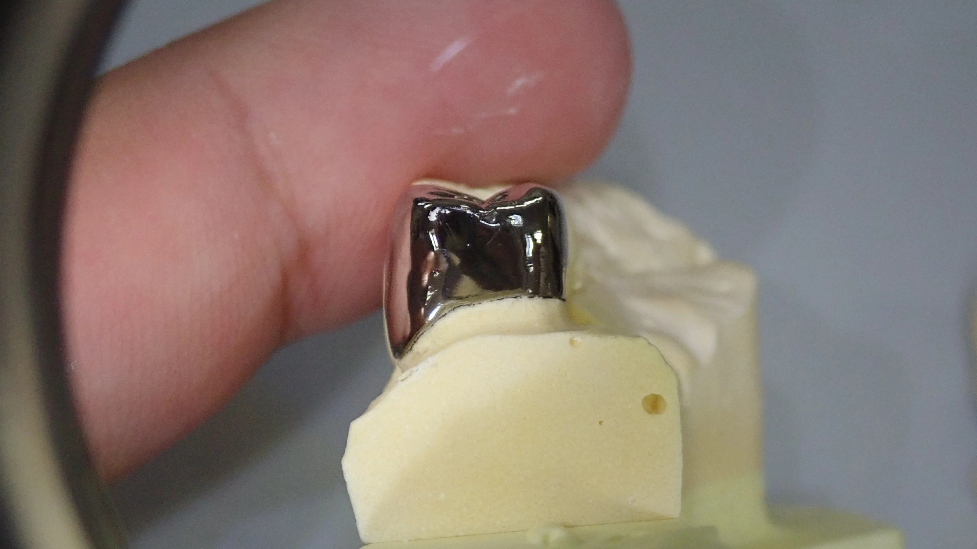 メタルクラウン|坂寄歯科医院(取手市藤代) - 画像5