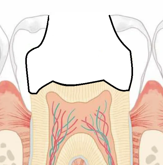 【歯科医師向け】重合収縮のコントロールについて【1級窩洞編】｜坂寄歯科医院（取手市藤代） - 画像3