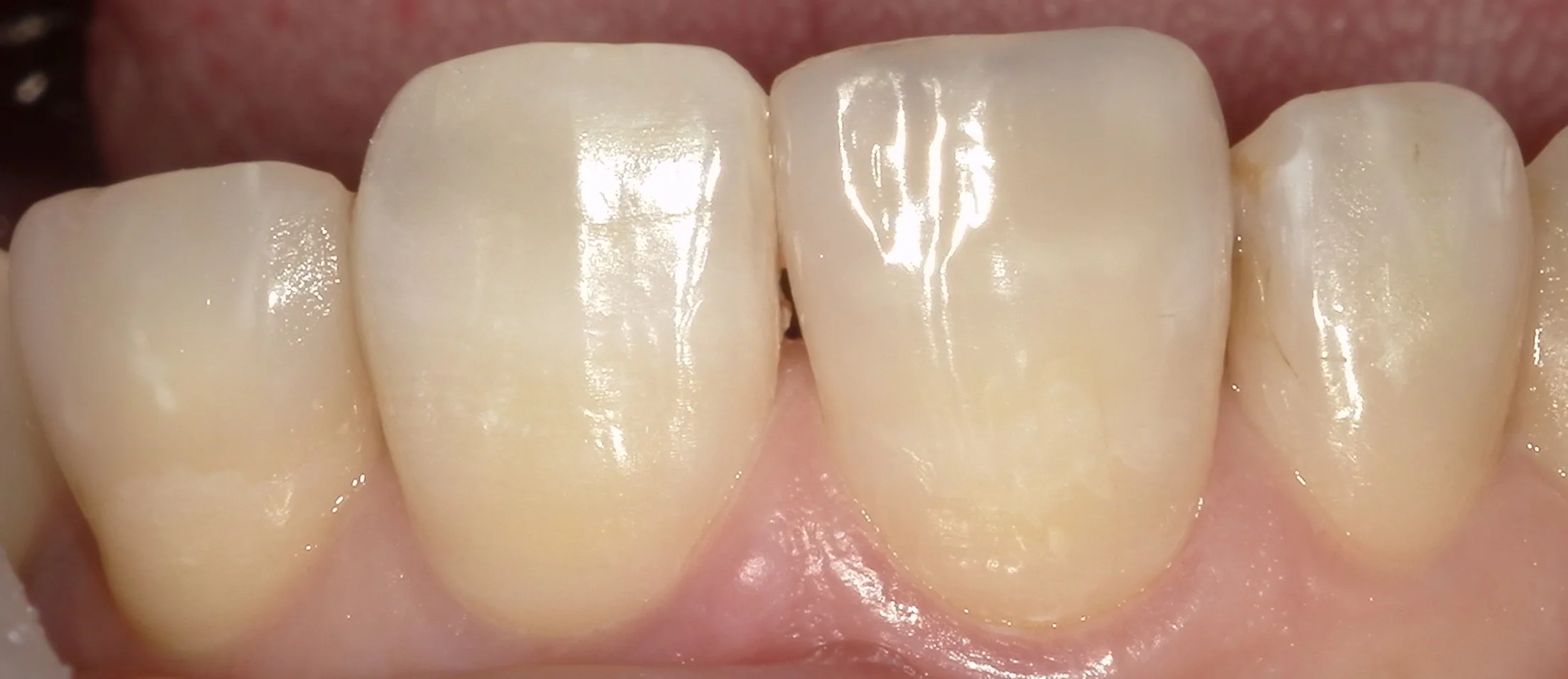 前歯が折れてしまったケース。|坂寄歯科医院(取手市藤代) - 画像3