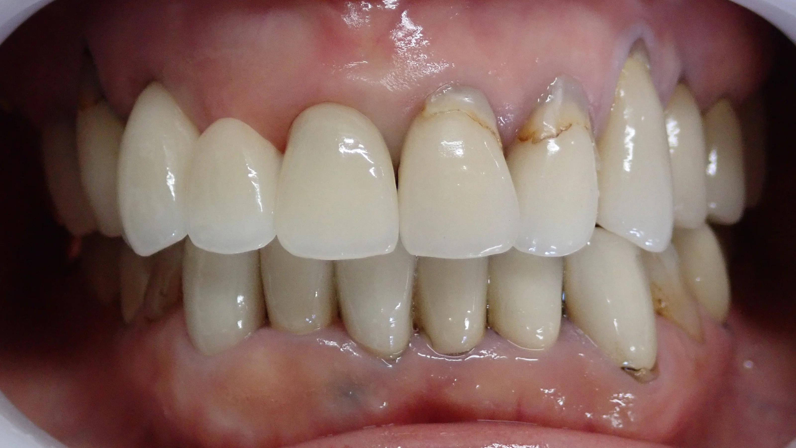 オールセラミックスブリッジ｜坂寄歯科医院（取手市藤代） - 画像2