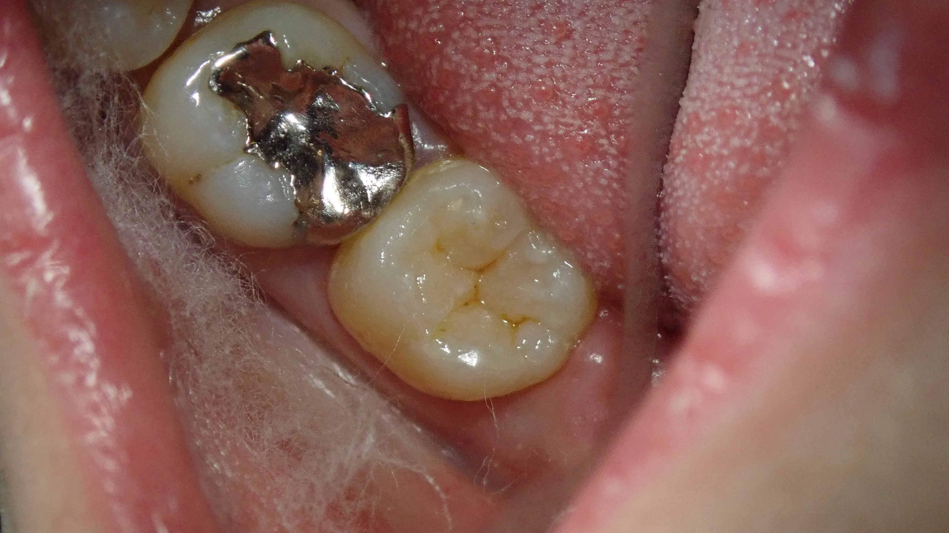 奥２本のダイレクトボンディング｜坂寄歯科医院（取手市藤代） - 画像3