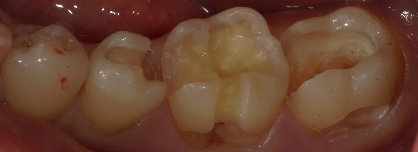 遠方から纏めて治療を希望の方。｜坂寄歯科医院（取手市藤代） - 画像3