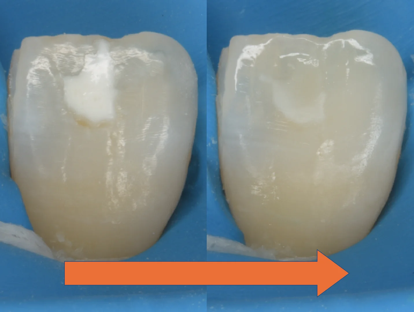 ICON治療にて改善しきらなかったケース。|坂寄歯科医院(取手市藤代) - 画像2