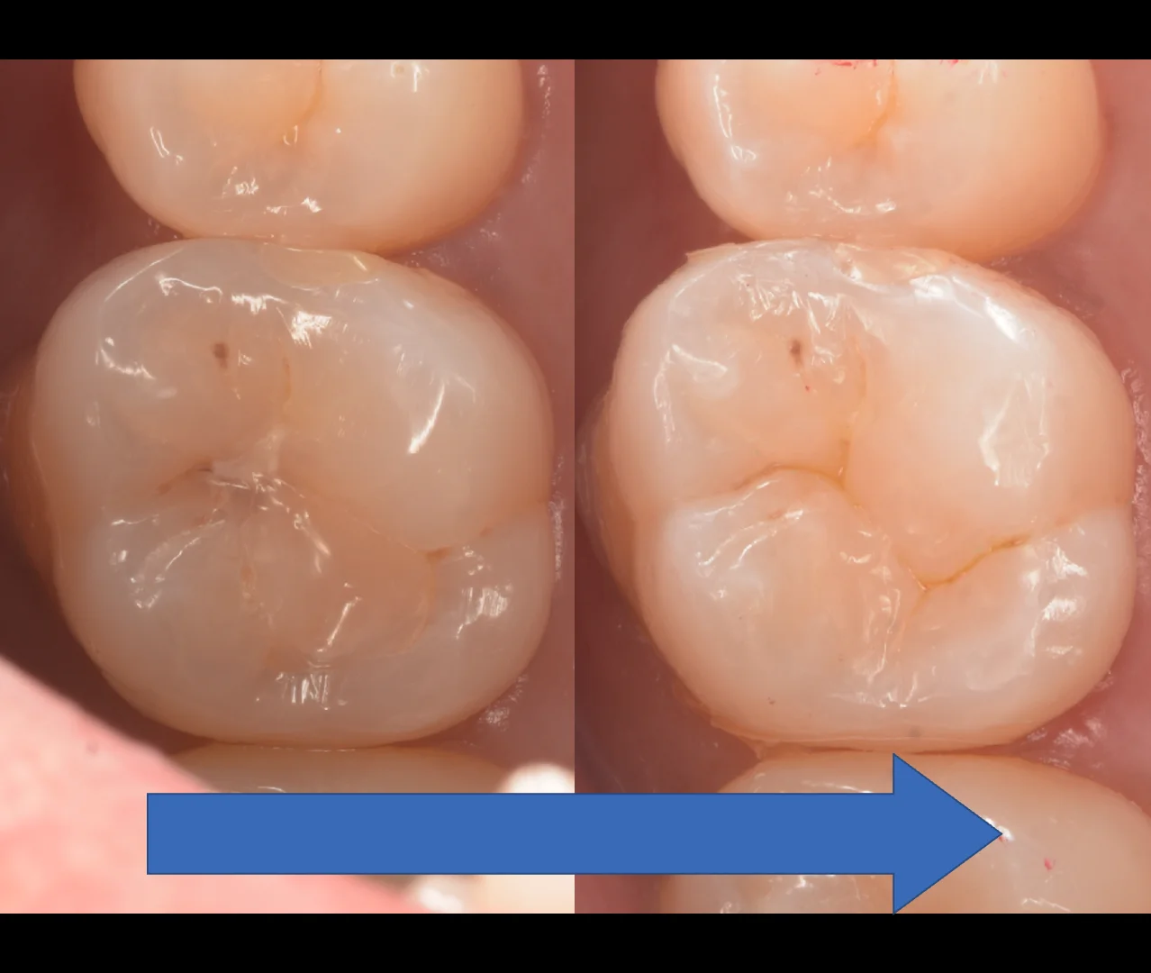 印西からお越しの方。｜坂寄歯科医院（取手市藤代） - 画像6